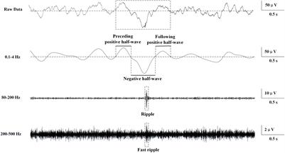 Association Between Interictal High-Frequency Oscillations and Slow Wave in Refractory Focal Epilepsy With Good Surgical Outcome